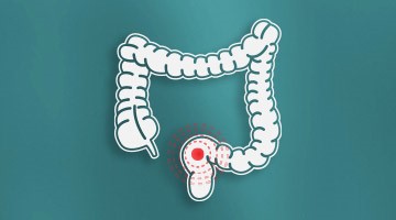 image_bowelcancersurgery