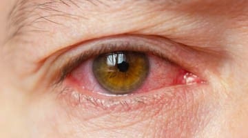 image_conjunctivitus