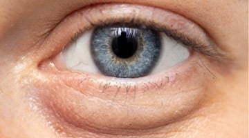 image_eyelidbags