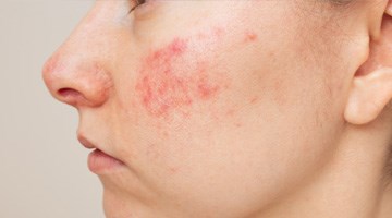image_whatisrosacea