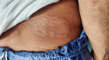 Everything you need to know about ringworm