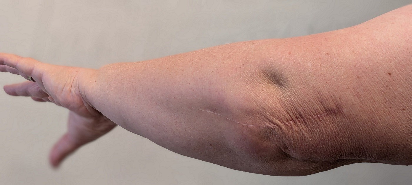 From pain to possibility: ‘How a rare total elbow replacement transformed my life!’